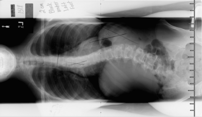 Scoliosis Xray